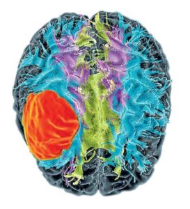 brain tumor scan